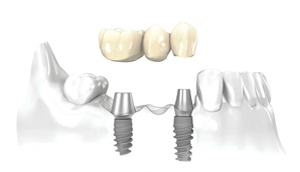 Perfect Smile Screw Retained Implant Supported Bridge